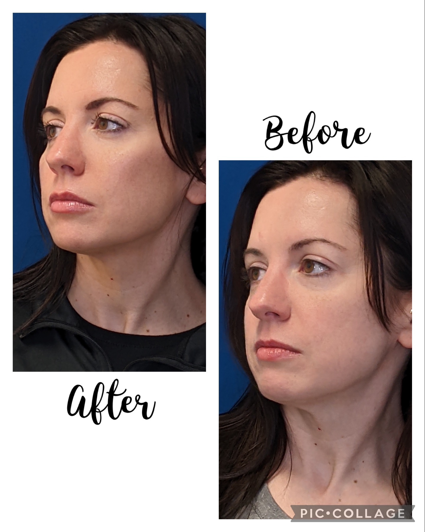 A patient's before-and-after photos reveal more lifted, defined contours after dermal fillers in Beloit.